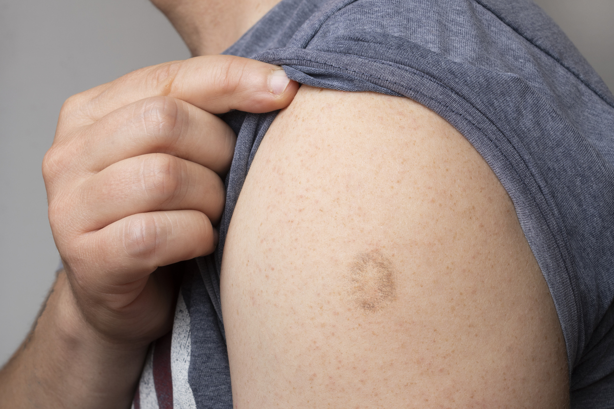 A symptom of monkeypox on an arm